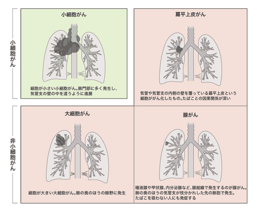 肺癌 の 疑い 不安