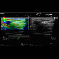 超音波診断 画像