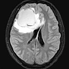 頭部MRI