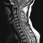 MRA頚椎MRI