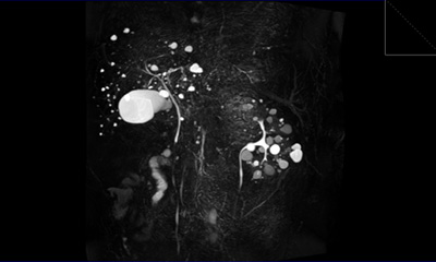 胆嚢、胆管、膵管を写し出すMRCP撮影