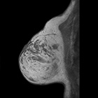 乳腺の精密検査の為の高分解能撮影