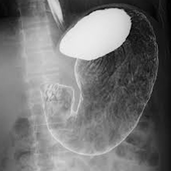 胃バリウム検査X線画像