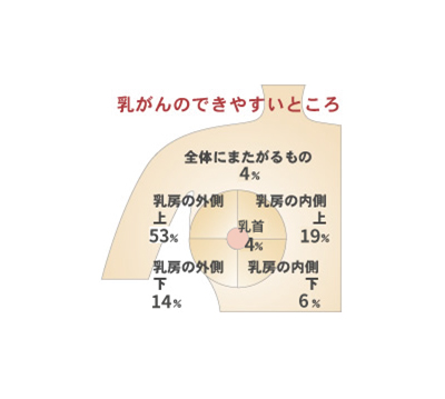 大腸がんの発生過程