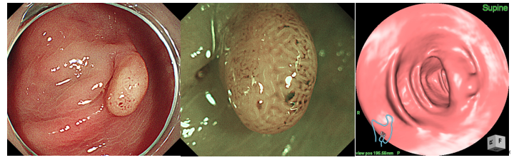 図　腺腫性ポリープの内視鏡画像と大腸CT画像