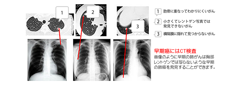 肺がん 病気について知る 人間ドック 健診会 東京メディカル