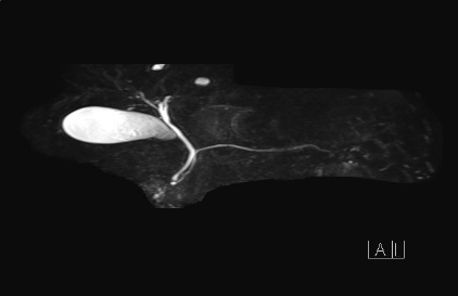 mrcp と mri の 違い