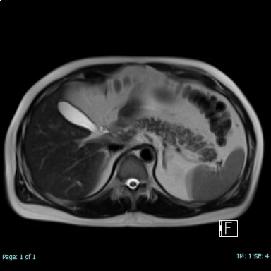 腹部MRI_T2強調画像_横断像