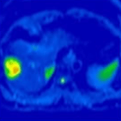 腹部MRI_拡散強調像_横断像