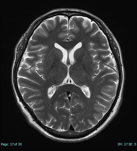 頭部MRI_T2強調画像_横断像