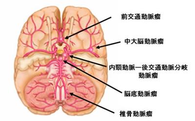 脳動脈瘤の好発部位