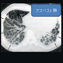 アスベスト肺